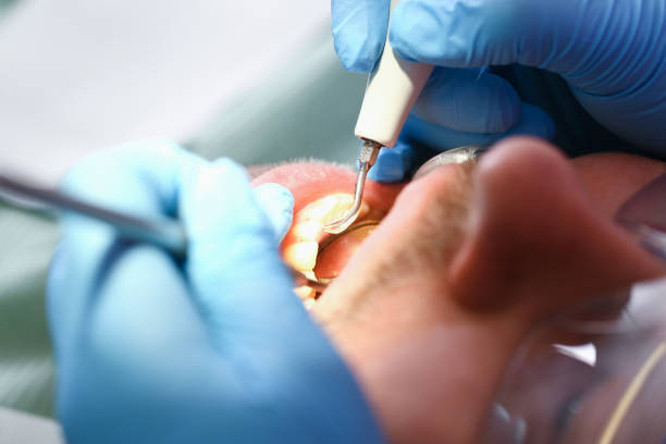 Best Emergency Wisdom Teeth Removal in Marathon, FL